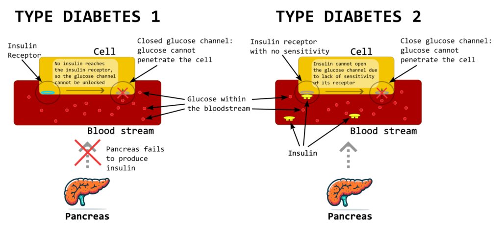 how the glucose absorption by the cell in individuals with both type 1 and type 2 diabetes is blocked